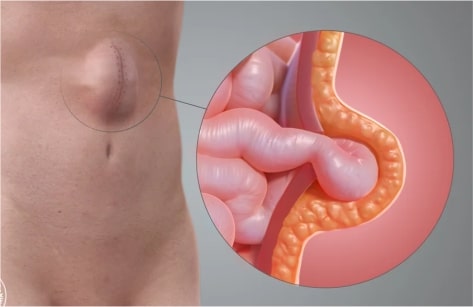 Surgical Management Of Hernia